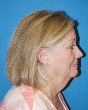 Facelift/Necklift