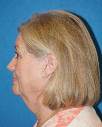 Facelift/Necklift