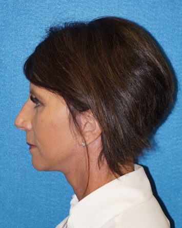 Facelift/Necklift