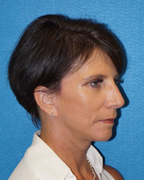 Facelift/Necklift