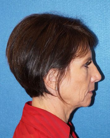 Facelift/Necklift