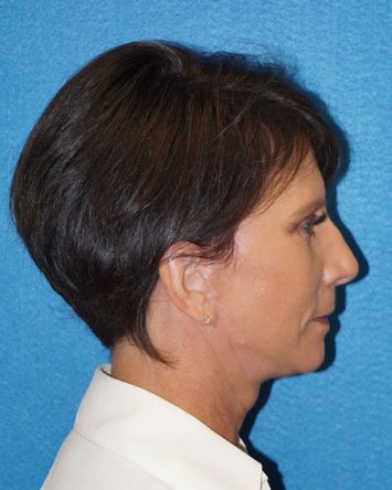 Facelift/Necklift