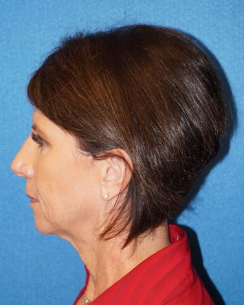 Facelift/Necklift