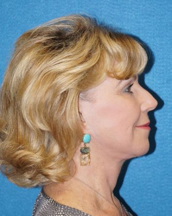 Facelift/Necklift