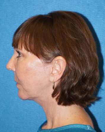 Facelift/Necklift