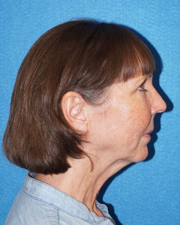 Facelift/Necklift