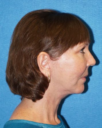 Facelift/Necklift