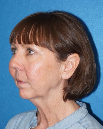 Facelift/Necklift