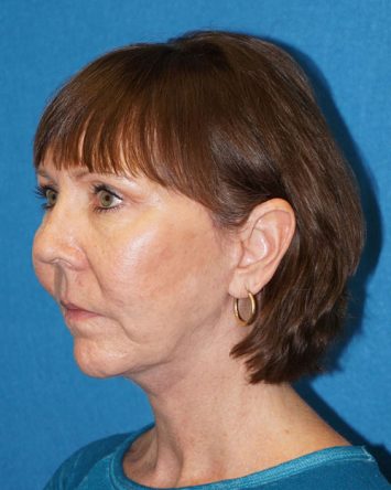 Facelift/Necklift