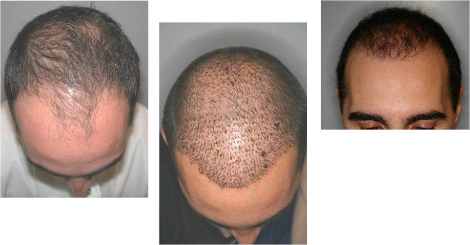 NeoGraft Before and After