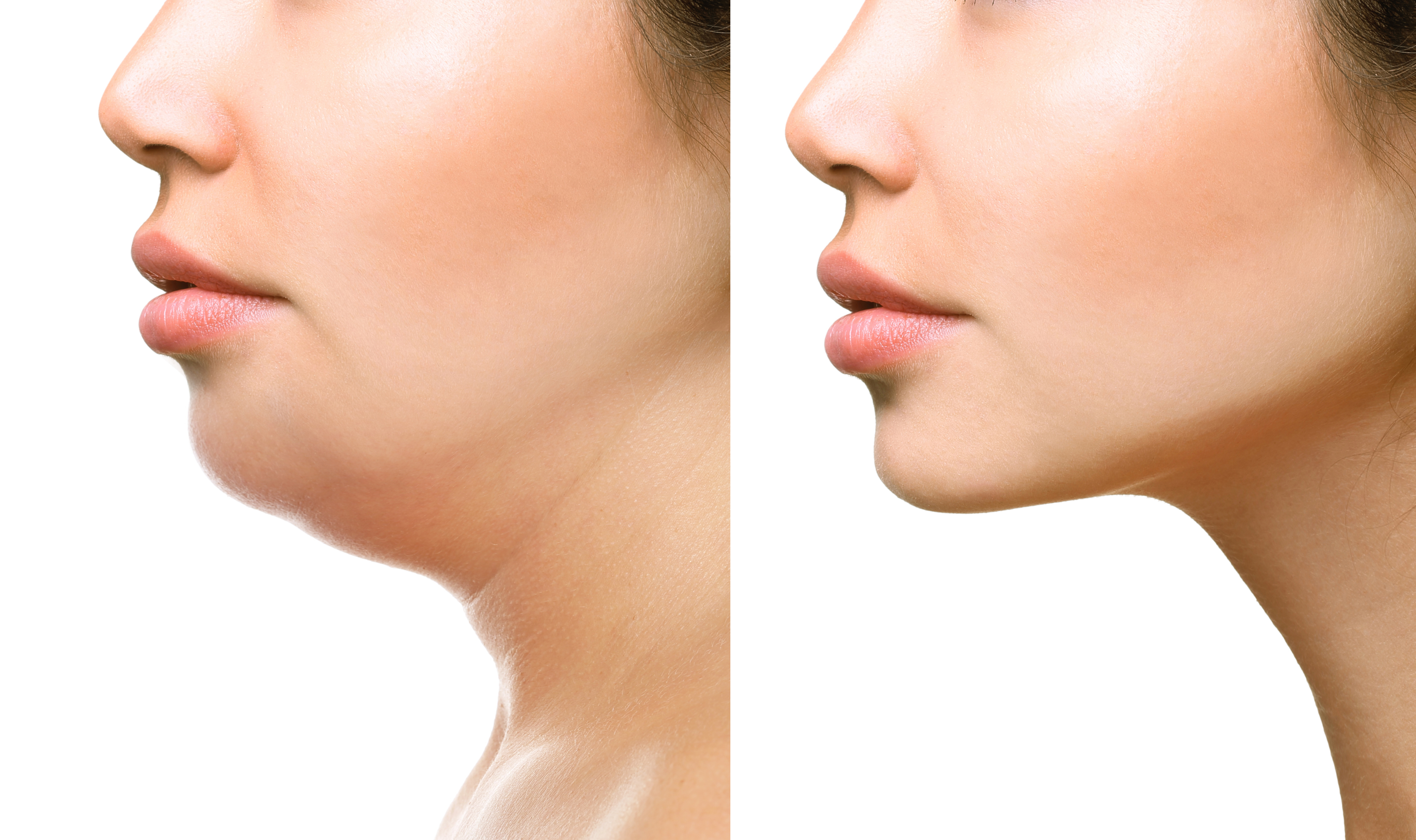 How to Get Rid of a Double Chin Without Surgery? 