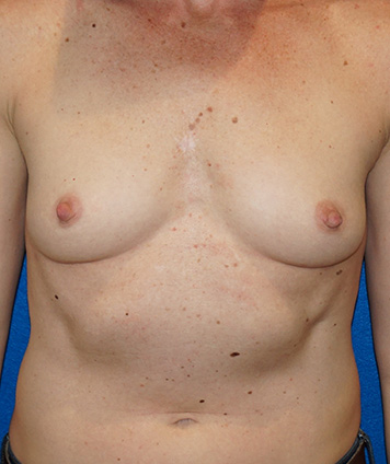 Breast Augmentation