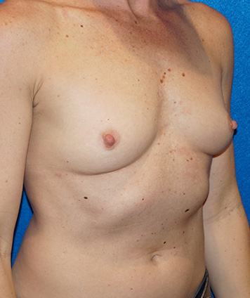 Breast Augmentation