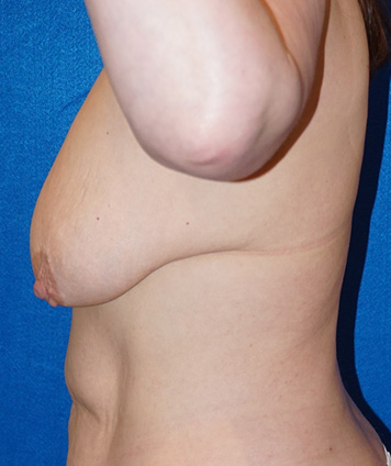 Mastopexy & Breast Augmentation (Breast Lift w Aug)