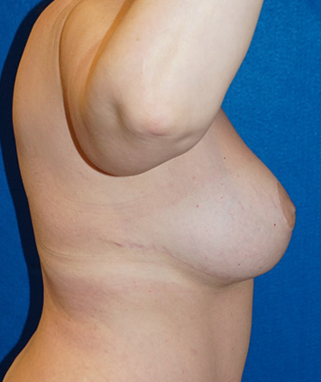 Mastopexy & Breast Augmentation (Breast Lift w Aug)