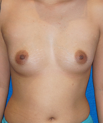 Breast Augmentation