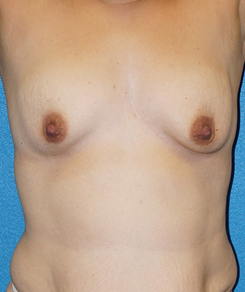 Breast Augmentation