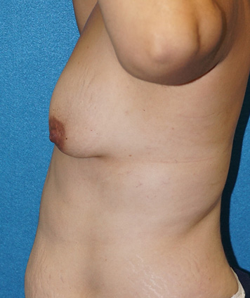 Breast Augmentation