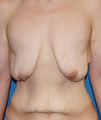 Mastopexy & Breast Augmentation (Breast Lift w Aug)