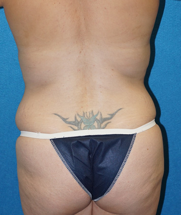 Tummy Tuck