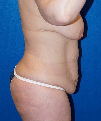 Tummy Tuck