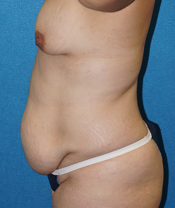 Tummy Tuck