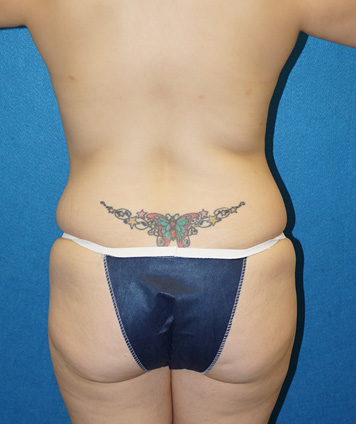 Tummy Tuck