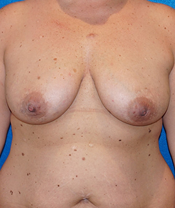 Mastopexy & Breast Augmentation (Breast Lift w Aug)