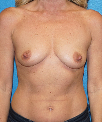 Breast Augmentation