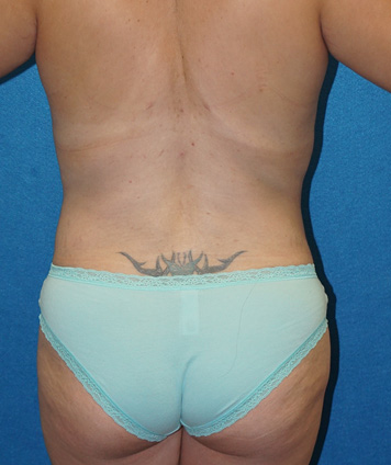 Tummy Tuck