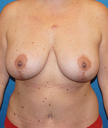 Mastopexy & Breast Augmentation (Breast Lift w Aug)