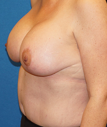 Mastopexy & Breast Augmentation (Breast Lift w Aug)