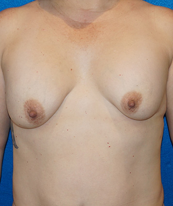 Mastopexy & Breast Augmentation (Breast Lift w Aug)