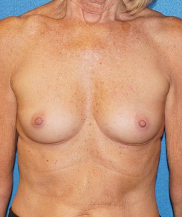 Breast Augmentation