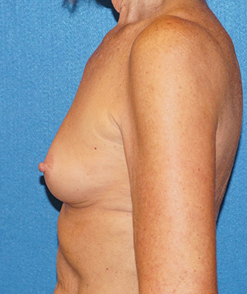 Breast Augmentation