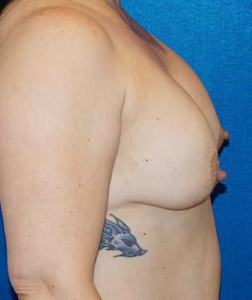 Mastopexy & Breast Augmentation (Breast Lift w Aug)