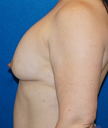 Mastopexy & Breast Augmentation (Breast Lift w Aug)