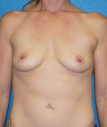 Breast Augmentation