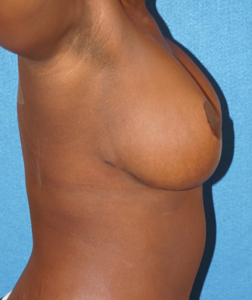 Mastopexy & Breast Augmentation (Breast Lift w Aug)