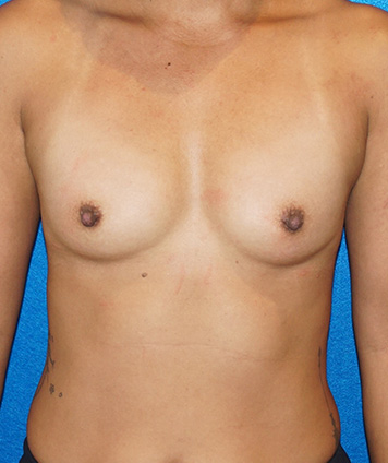 Breast Augmentation