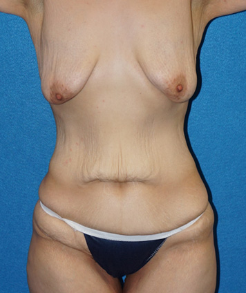 Tummy Tuck