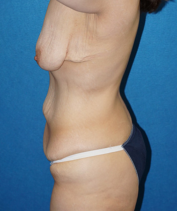 Tummy Tuck