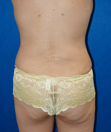 Tummy Tuck