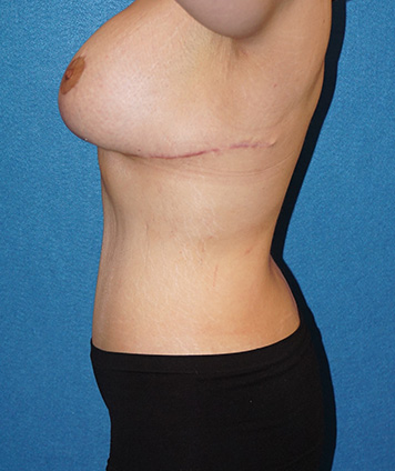 Tummy Tuck