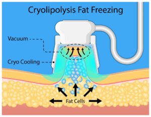 CoolSculpting in Sacramento