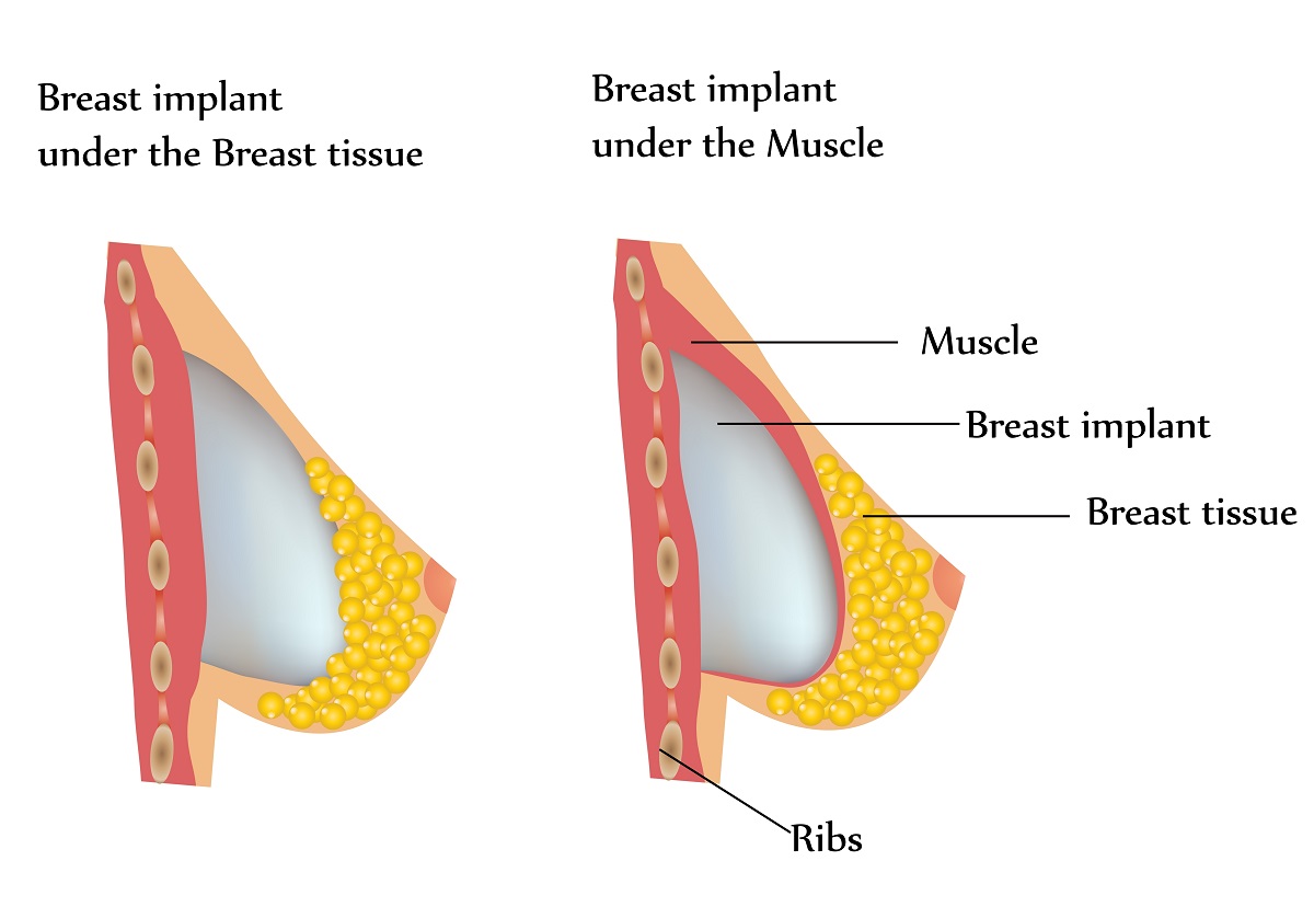 Fake natural looking breast implants vs Fake Looking