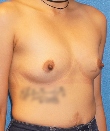 Breast Augmentation