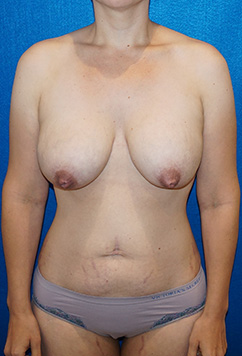 Tummy Tuck