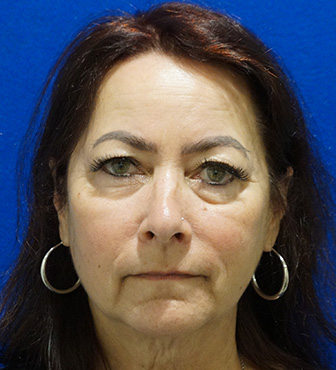 Blepharoplasty