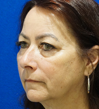 Blepharoplasty